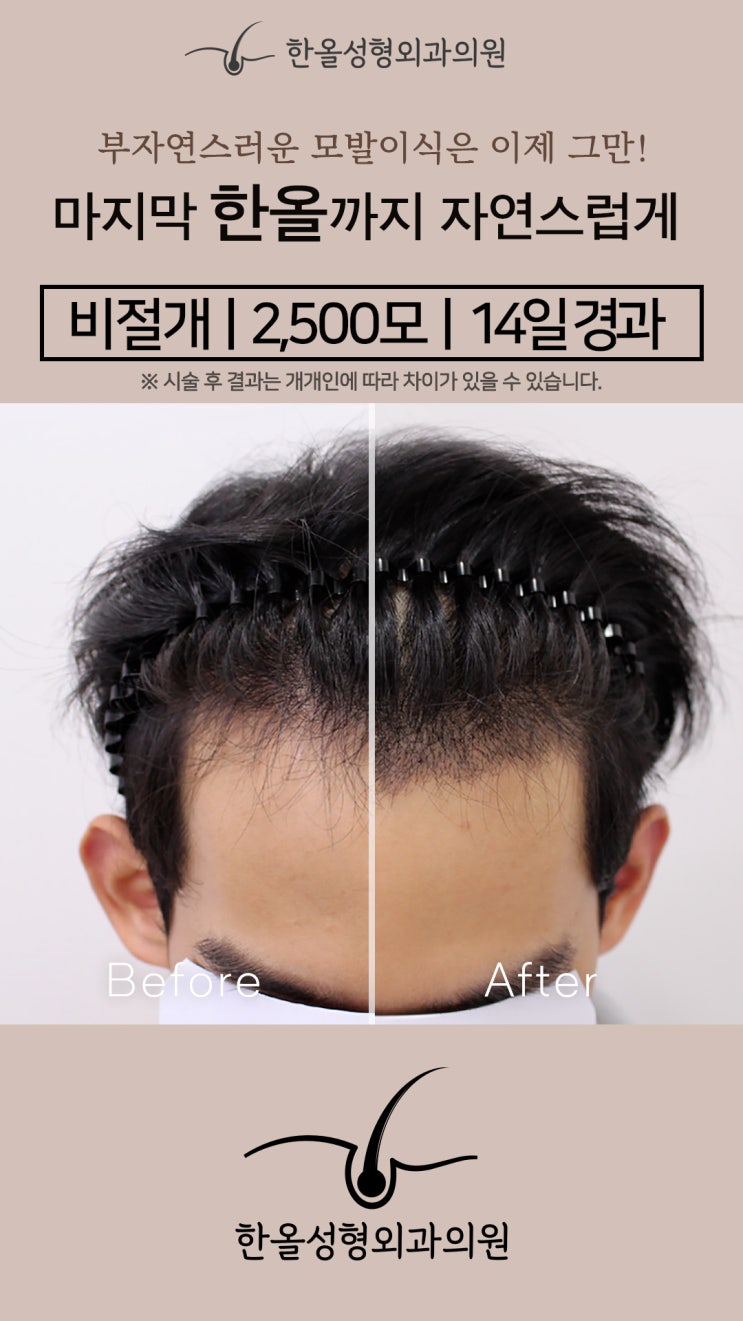 [한올성형외과] 비절개모발이식 2500모 14일 경과 - 모발이식 비용 ㅣ헤어라인 모발이식ㅣ모발이식 생착률ㅣ모발이식 가격ㅣ모발이식 후기