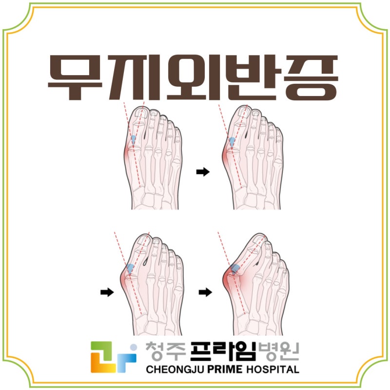 청주병원 엄지발가락 휘어져 통증 유발하는 무지외반증 방치하면 안 돼