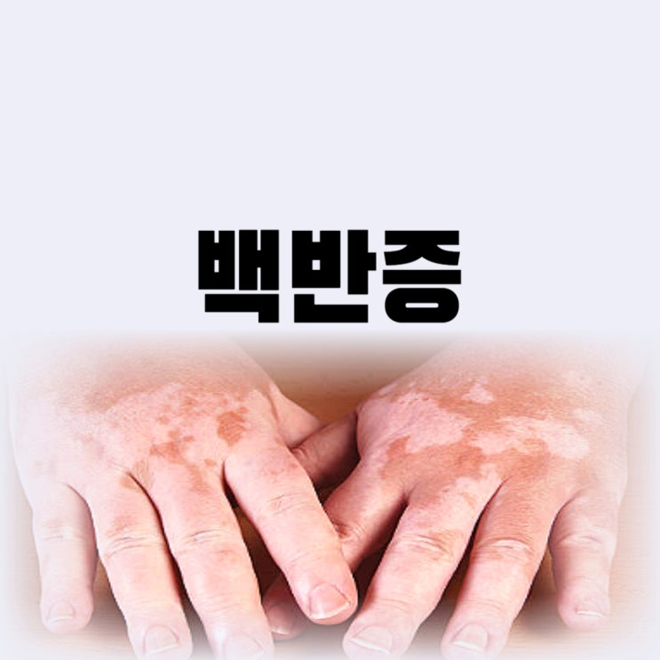  얼굴 백반증 원인 번짐 유아 백반증 치료 재발까지
