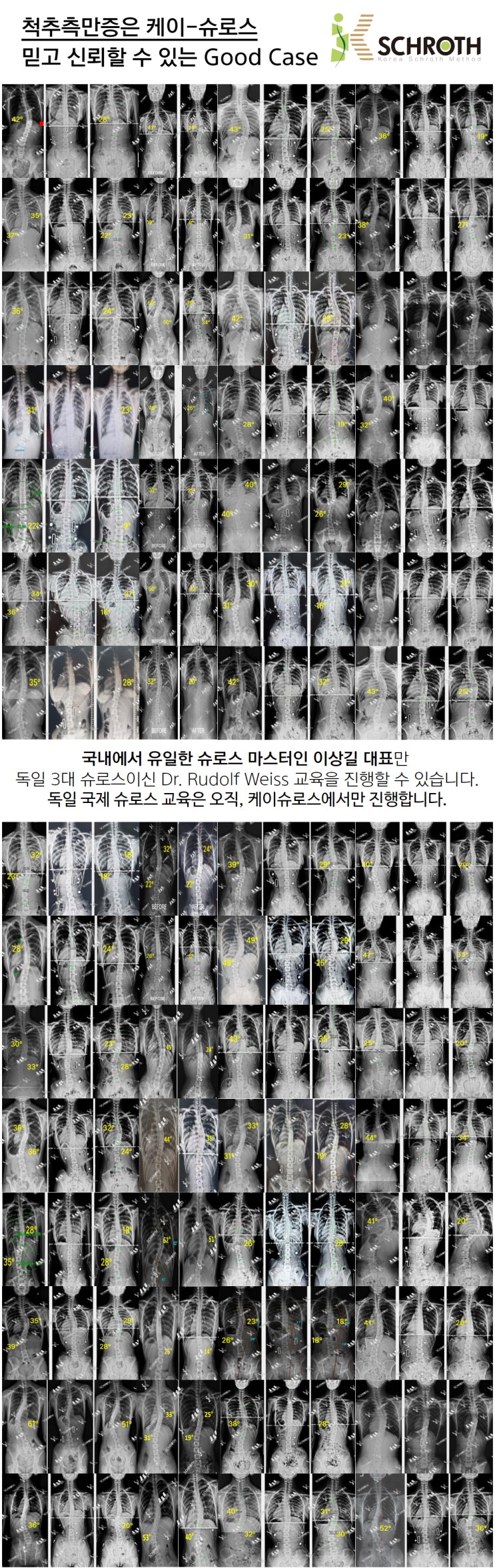  척추측만, 척추에 특화된 운동 케이슈로스 그 결과로 답하겠습니다