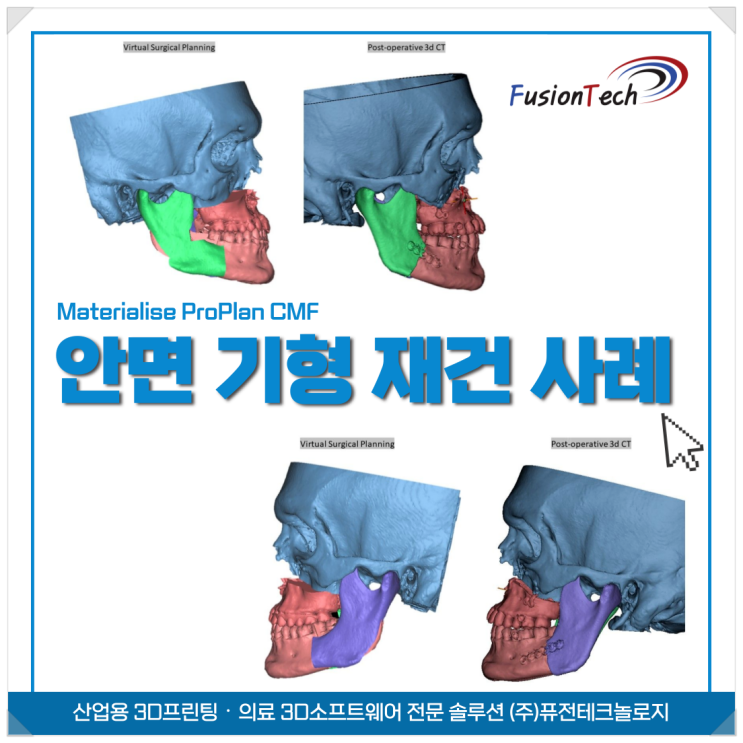  [Materialise 활용사례] 가상 수술 계획과 3D프린팅 기술을 활용한 안면재건 사례