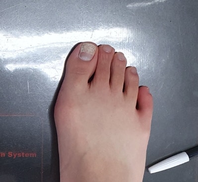  성장기 무지 외반증, 선천적인가? 교정이 될까?