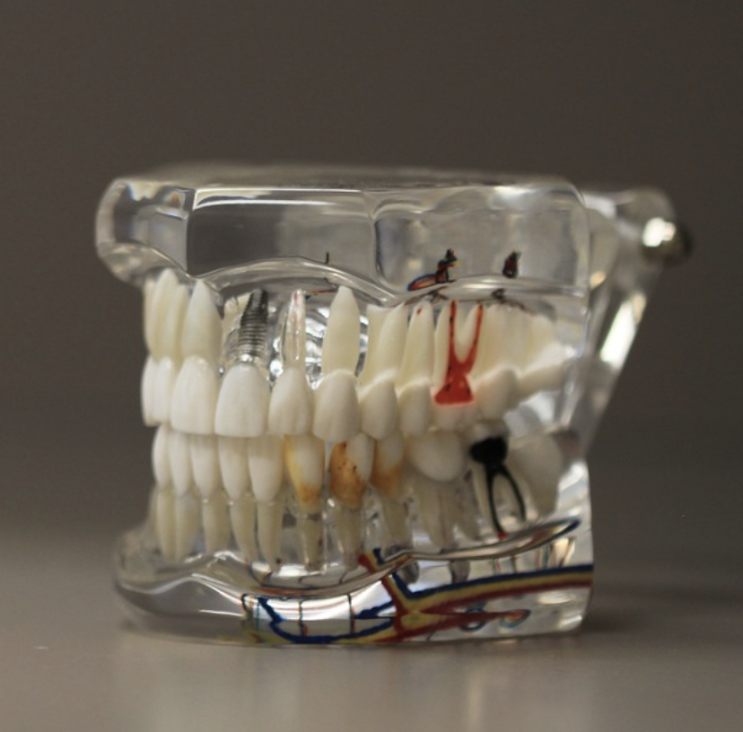 신경치료 받은 치아도 교정치료 할 수 있나요? 신경치료 치아교정 가능할까?