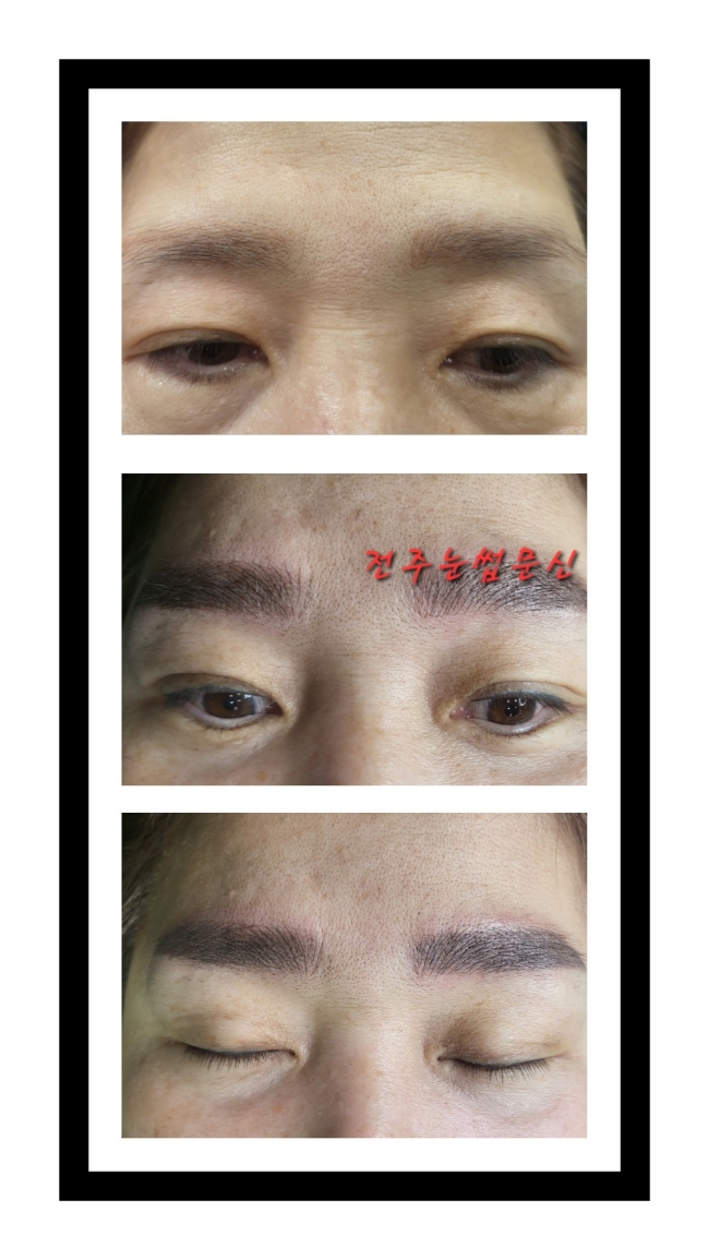  전주눈썹문신 제거 잔흔커버