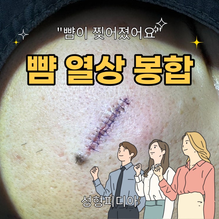  [열상] 뺨이 찢어졌어요. 찢어진 얼굴 열상 봉합 과정. (feat. 성형외과 얼굴 봉합, 성형외과 전문의)