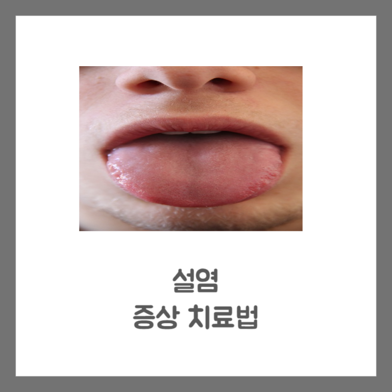 설염 원인 증상 치료 혀 혓바닥 갈라짐 따가움