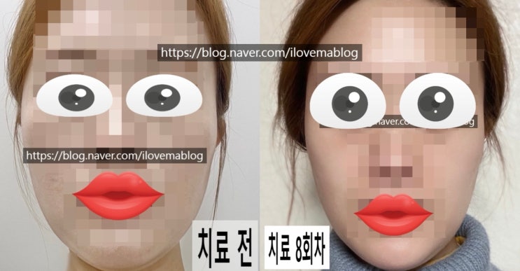 [턱관절 치료기 4] 한쪽 턱 통증 비대칭 치료 8회차 후기