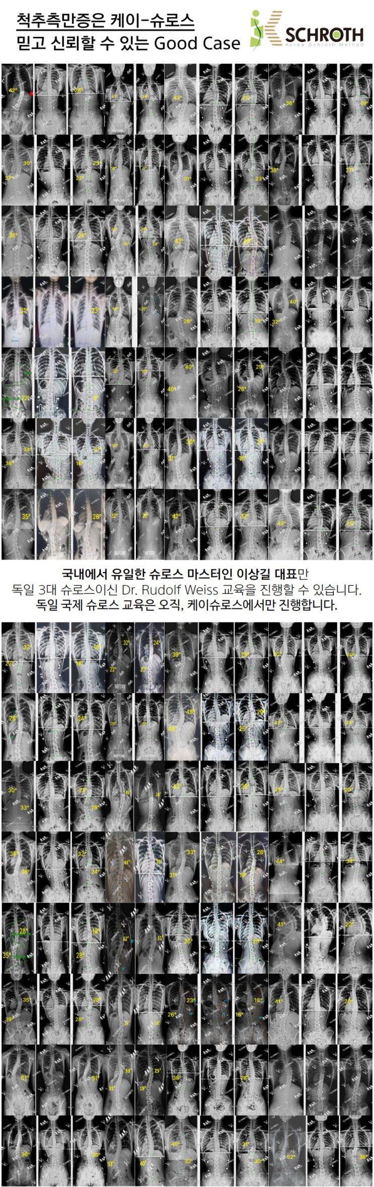  척추측만특화운동 케이슈로스의 슈로스 운동 전후