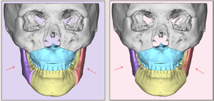 주걱턱 긴얼굴 SSRO BSSRO IVRO VRO 양악수술로 얼굴이 작아지는 두가지 원리 - 하악지각도 조절 교합면 상방이동