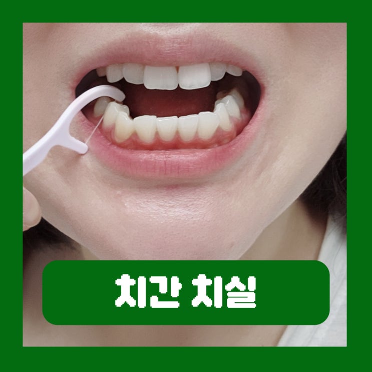  치간 치실 종류 사용해야 하는 이유 부드러운 오라덴스 개별포장 일회용치실