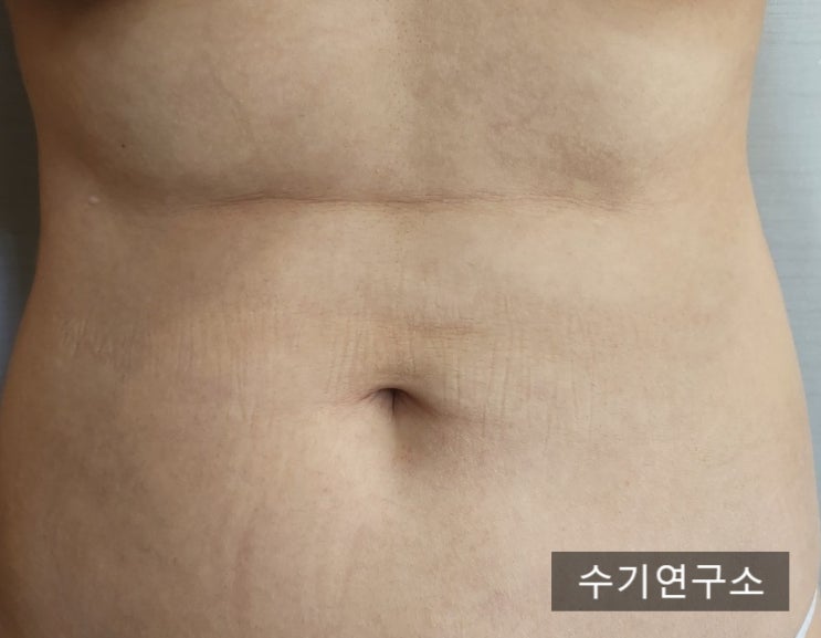  아랫배 지방흡입 울퉁불퉁한 것도 유착 맞죠?
