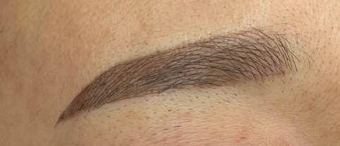  울퉁불퉁 반영구 잔흔, 상흔일까?