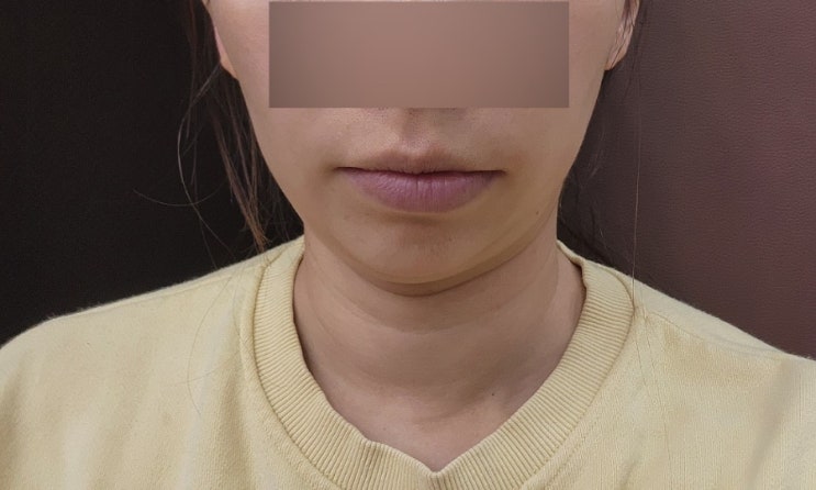  킬본교정 월치료 후기 강남교정치과