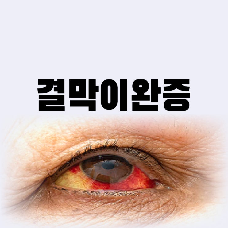 결막이완증 원인 눈을 비벼서 생긴다면