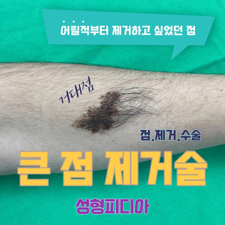  [점] 큰 점 단계별 제거술, 1차 점 제거수술 (feat. 성형외과 전문의)