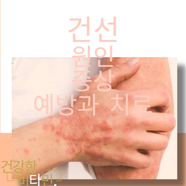 건조한 피부 건선 가려움증 가려움 원인 및 증상 예방과 치료하기