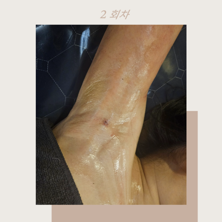  팔뚝 지방흡입 바이오본드 시간이 지나면 풀어지나요?