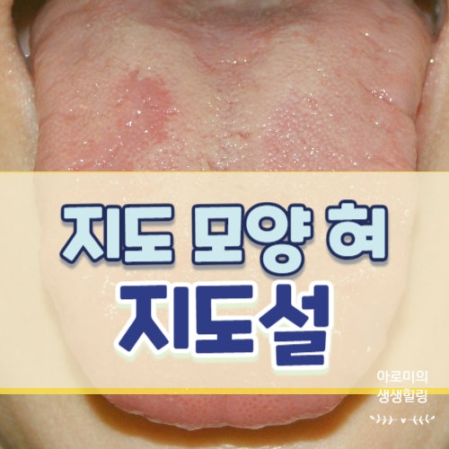 혀에 생겨난 불규칙한 지도 무늬, 지도혀 지도설