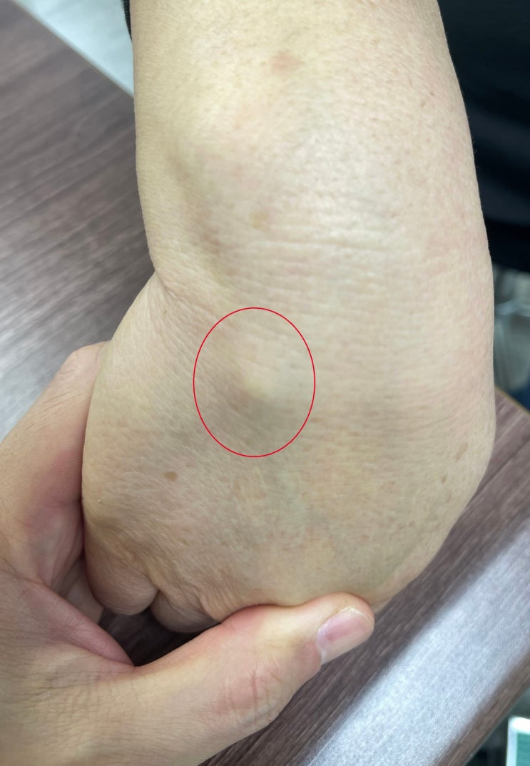  천호동 정형외과, 손등혹, 물혹, 손등뼈 치료