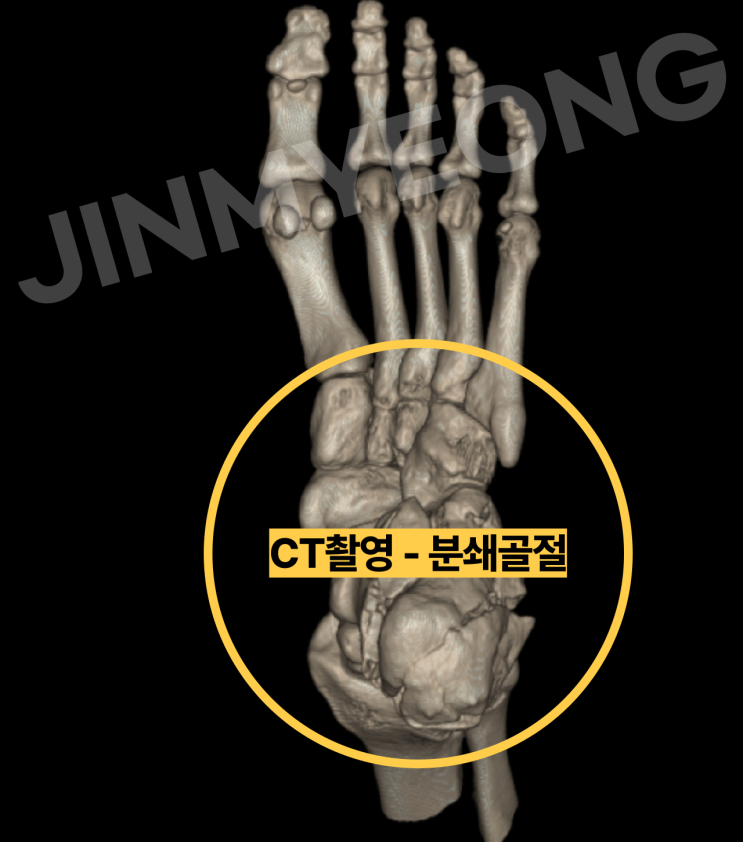  종골 분쇄골절 S9200 수술 후 상해후유장해 보험금 보상사례