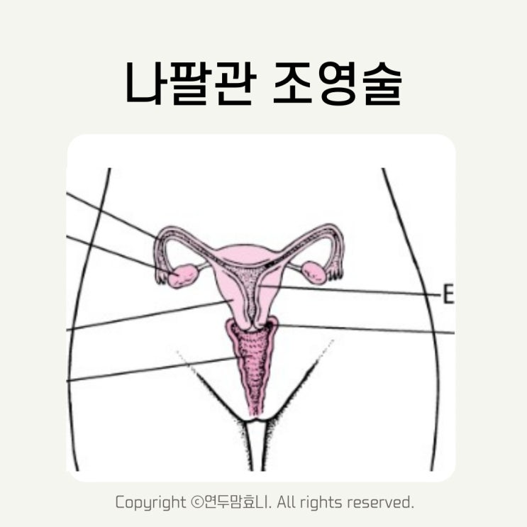 나팔관조영술 시기 생리 비용 실비 결과 통증 난임검사 후기 나팔관조영술 시기 생리 비용 실비 결과 통증 난임검사 후기