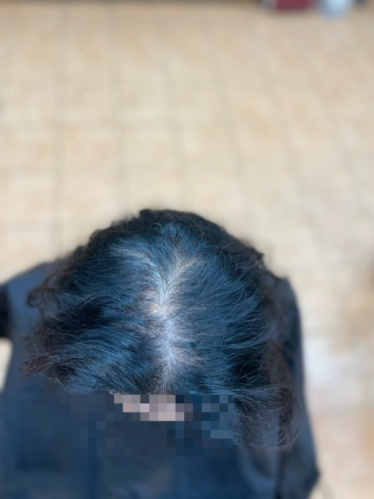  심한여성탈모펌과 복구클리닉 시술후 부산 사상구 르네시떼미용실