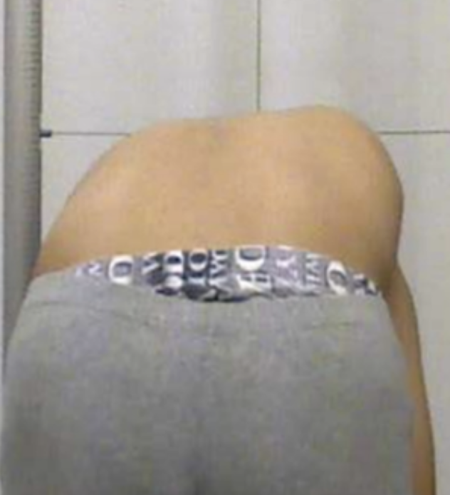  척추측만증 환자의 대표적인 증상과 치료법? 흉추 측만 주목!