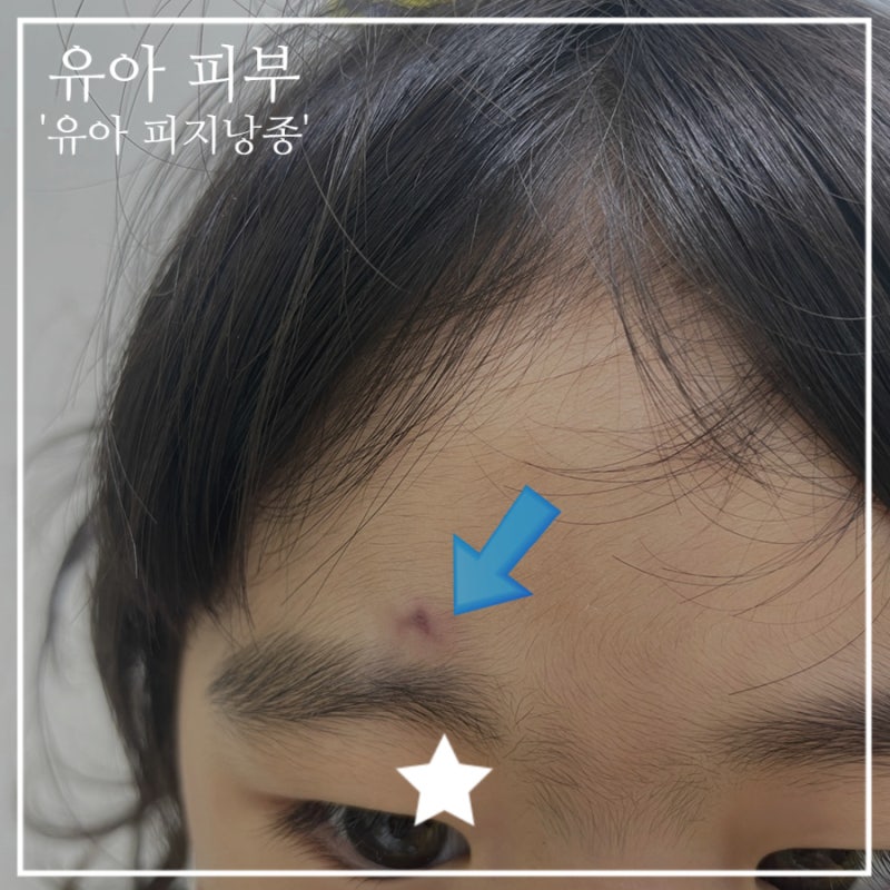 유아 뾰루지 피지낭종 상세 불명의 피부 양성 신생물로 병원 방문