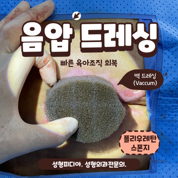  [음압드레싱] 음압 드레싱, 백, 큐라백 드레싱은 무엇인가요? (NPWT, feat. 성형외과 전문의)