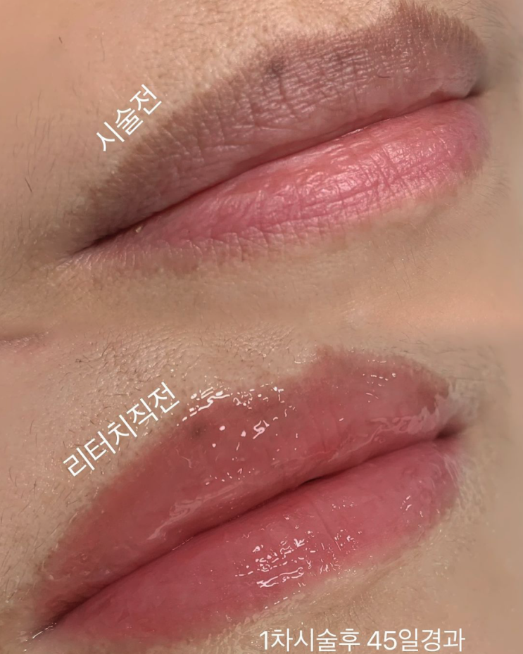  어두운 입술 테두리 교정 타투