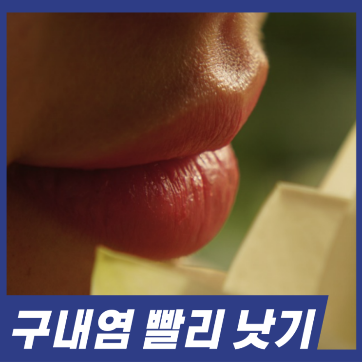  구내염 빨리 낫는법! 단계별 사용하는 구내염 약 알고가세요.