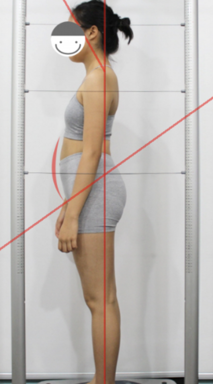  고관절 및 골반 통증, 골반 불균형이 원인? 체형교정과 통증치료 방법(체외충격파, 줄기세포치료 등)