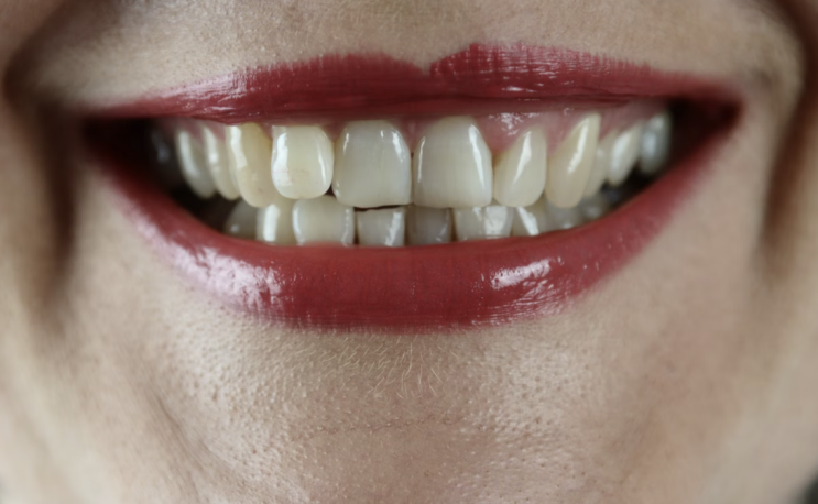 치아가 변색되는 이유, 치아가 노래지는 이유? 치아변색과 치아미백술