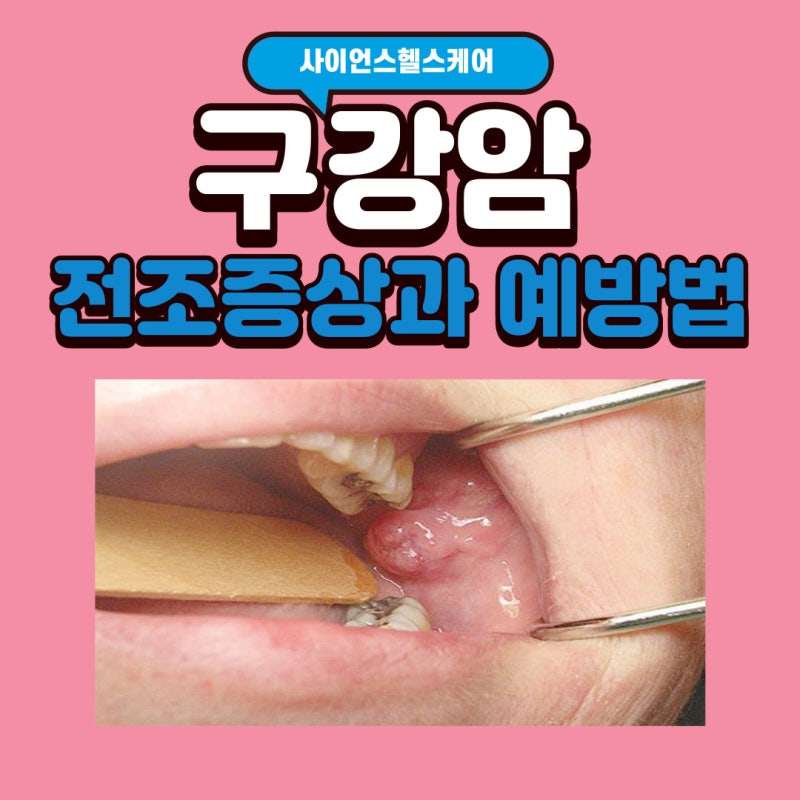 구강암 초기 전조증상과 구강암 3기 4기 종류 예방법