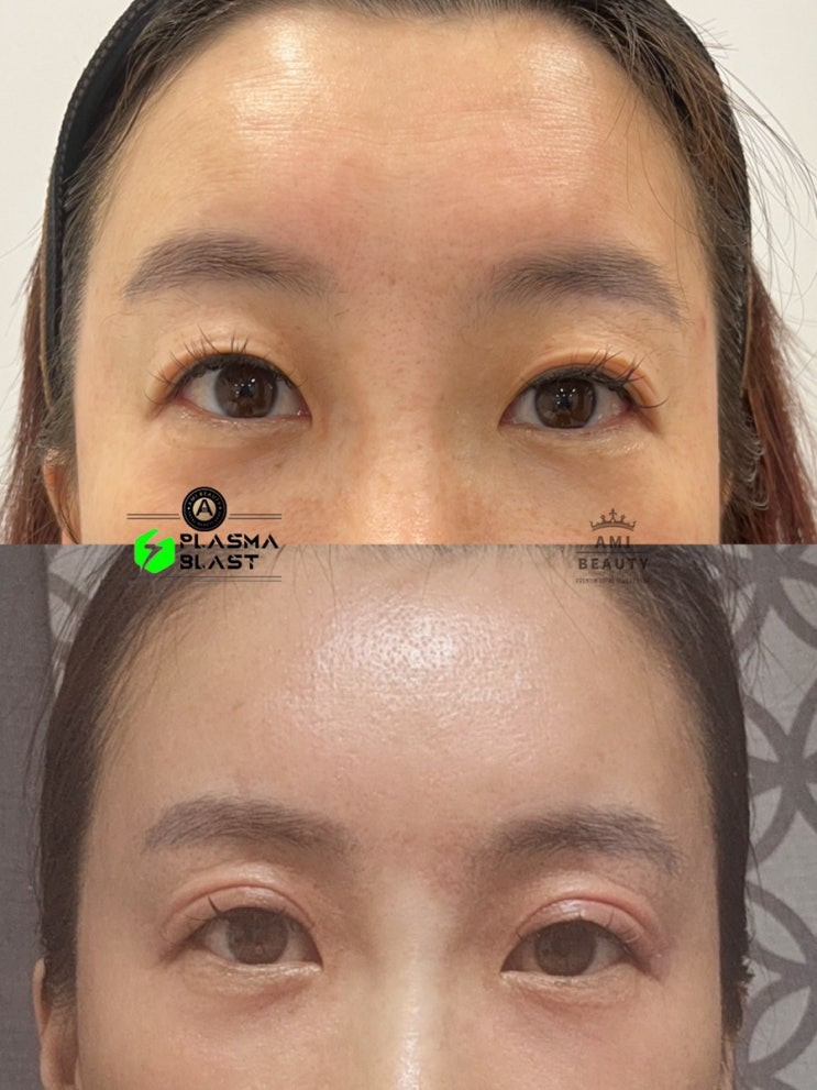  대구 플라즈마 주름 탄력 리프팅 쳐진쌍꺼풀 꺼진눈밑 상안검 하안검 10년 동안 되는 비법 아미뷰티 에서  알려드립니다!!!