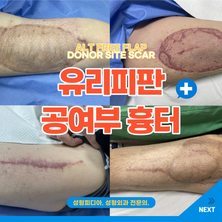  [유리피판] 유리피판 수술 공여부 흉터 (ALT free flap, 전외측대퇴부 유리피판 허벅지 흉터, feat. 성형외과 전문의)
