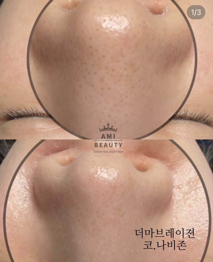  대구  코모공 피지 블랙헤드 화이트헤드에 효과적인 크리스탈필링  물광 모찌피부원하시면 클릭!!(아미뷰티)