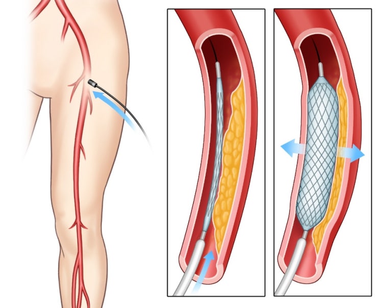  의학용어 의료용어 정리 모음(PAD, PCA, PCNA, PD, PKD, PSC, PTA)