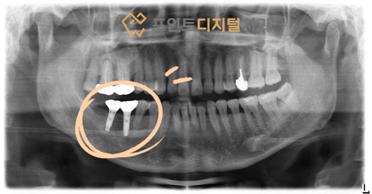  [탕정치과] 임플란트 17년 경과(차오름) / 천안 아산