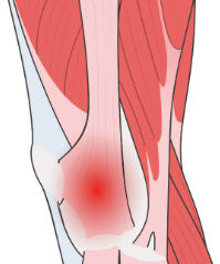  축구 무릎 통증의 범인은 따로 있다![삼성동 재활 PT]