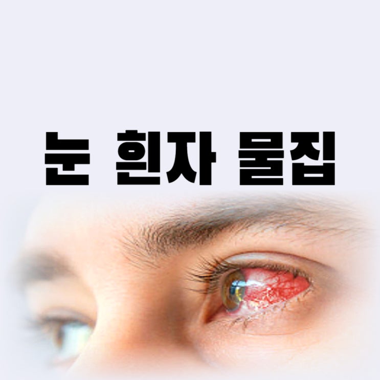  눈 흰자 물집 결막낭종 원인 증상 알면 치료 가능할까