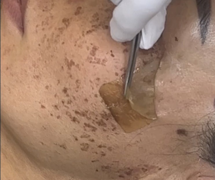  대구 콜드플라즈마 얼굴잡티 흑자 다크써클 눈밑꺼짐 팔자주름 볼탄력 모든게 다 고민이신분 !!!해결방법 알려드립니다