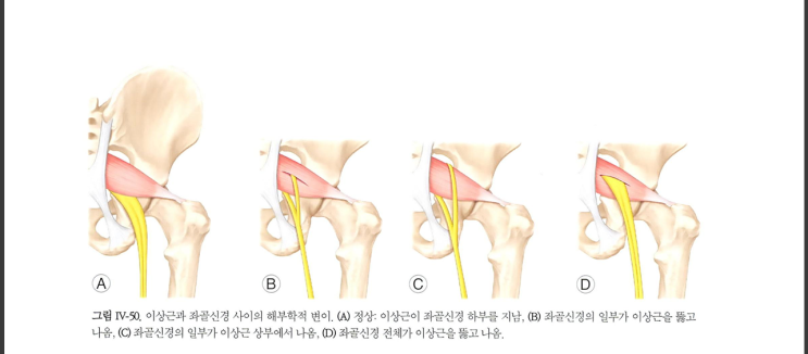  앉았다가 일어날때 발생하는 엉덩이 통증/ 좌골신경통 치료