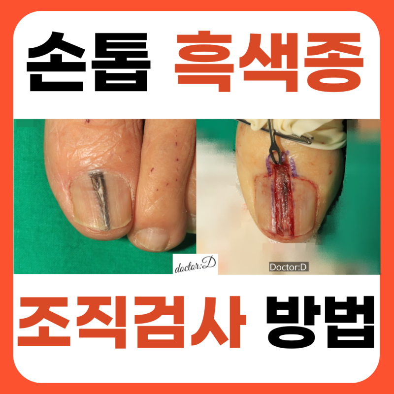 손톱 발톱 흑색종 조직검사 방법, 실제 사진 보여드립니다. (손톱 검은 세로줄)