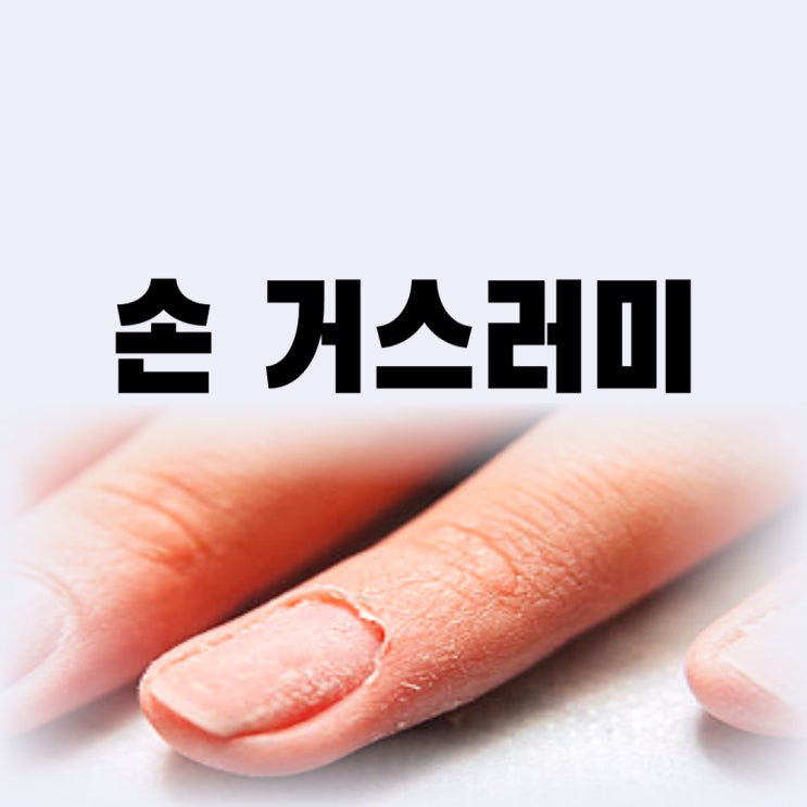 손 거스러미 원인 뜯으면 안 되는 이유 조갑주위염 고름 때문(까시래기)