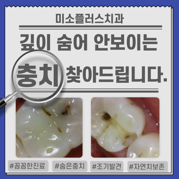  인레이치료4