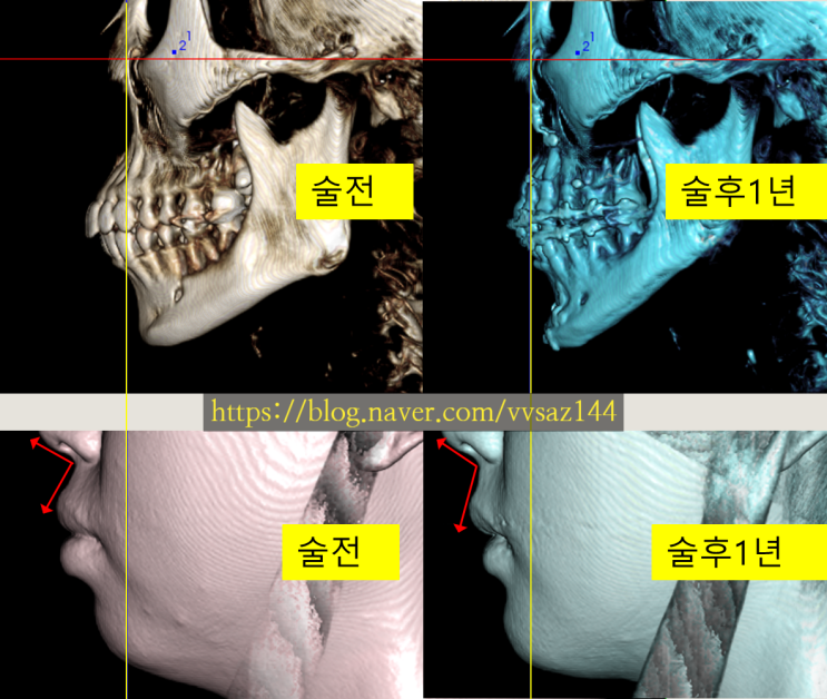 돌출입 ASO수술 후 입술모양 코모양 인중 턱밑살 변화  - 동일한 좌표계에서 연조직변화 관찰