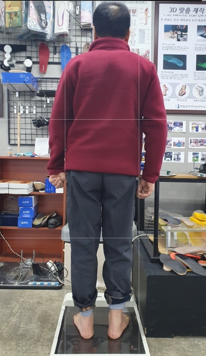  급성 척추 측만증, 요추 외측 변위(lumbar lateral shift), 근본적인 교정 방법은?