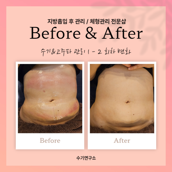  복부 지방흡입 바이오본드 개선을 위한 3 단계