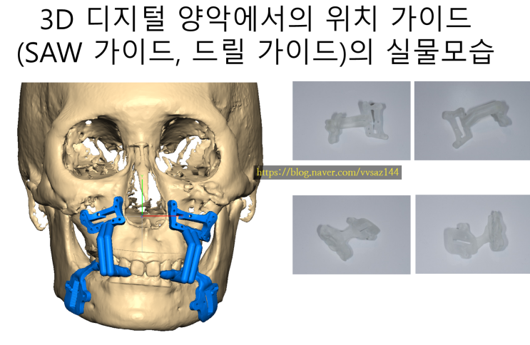 3D 디지털 디지탈 양악수술의 분류 - 페이스가이드, facegide (1)